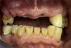 Rosenstein   Gartner Dentistry, PLLC | Implant Dentistry, Veneers and Periodontal Treatment