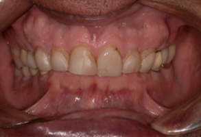 Rosenstein   Gartner Dentistry, PLLC | Teeth Whitening, Crowns  amp  Onlays and Dental Fillings