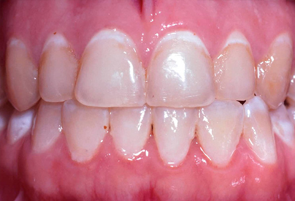 Rosenstein   Gartner Dentistry, PLLC | Crowns  amp  Onlays, Implant Restorations and Dental Cleanings