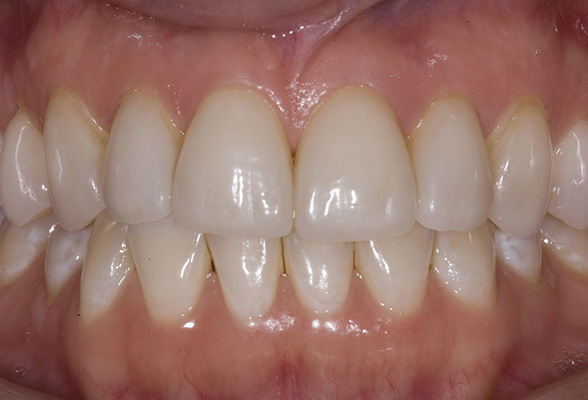 Rosenstein   Gartner Dentistry, PLLC | Digital Occlusal Analysis, Invisalign reg  and Periodontal Treatment