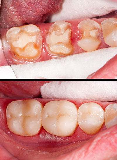 Rosenstein   Gartner Dentistry, PLLC | Preventative Program, Root Canals and Invisalign reg 