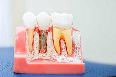 Rosenstein   Gartner Dentistry, PLLC | Periodontal Treatment, Digital Impressions and Dental Cleanings   Hygiene