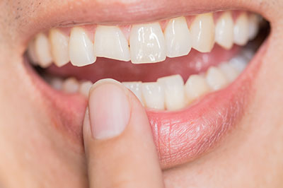 Rosenstein   Gartner Dentistry, PLLC | Invisalign reg , Dental Fillings and Dental Bridges