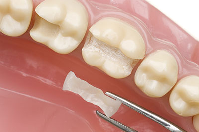 Rosenstein   Gartner Dentistry, PLLC | Invisalign reg , Guided Biofilm Therapy and Root Canals