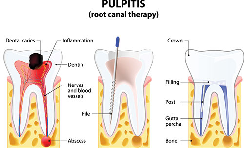 Rosenstein   Gartner Dentistry, PLLC | Preventative Program, Dental Fillings and Teeth Whitening