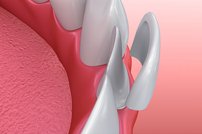 Rosenstein   Gartner Dentistry, PLLC | Complete   Partial Dentures, Veneers and Crowns  amp  Onlays