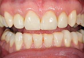 Rosenstein   Gartner Dentistry, PLLC | Digital Radiography, Complete   Partial Dentures and Invisalign reg 