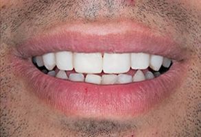 Rosenstein   Gartner Dentistry, PLLC | Preventative Program, Teeth Whitening and Dental Bridges