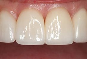 Rosenstein   Gartner Dentistry, PLLC | Teeth Whitening, Digital Radiography and Digital Occlusal Analysis