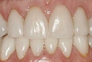 Rosenstein   Gartner Dentistry, PLLC | Dental Implants   Restorations, Complete   Partial Dentures and Dental Cleanings   Hygiene