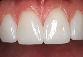 Rosenstein   Gartner Dentistry, PLLC | Dental Cleanings   Hygiene, Teeth Whitening and Dental Implants   Restorations