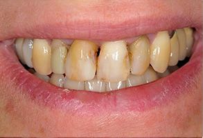 Rosenstein   Gartner Dentistry, PLLC | Complete   Partial Dentures, Teeth Whitening and Oral Cancer Screening