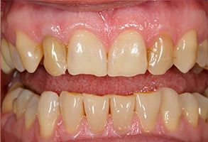 Rosenstein   Gartner Dentistry, PLLC | Dental Cleanings   Hygiene, Dental Bridges and Guided Biofilm Therapy