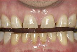 Rosenstein   Gartner Dentistry, PLLC | Dental Bridges, Complete   Partial Dentures and Root Canals