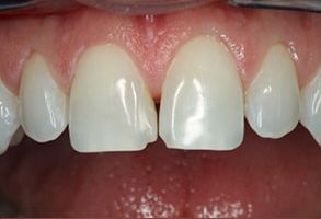 Rosenstein   Gartner Dentistry, PLLC | Crowns  amp  Onlays, Guided Biofilm Therapy and Preventative Program